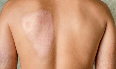 Photo for Burn Injury